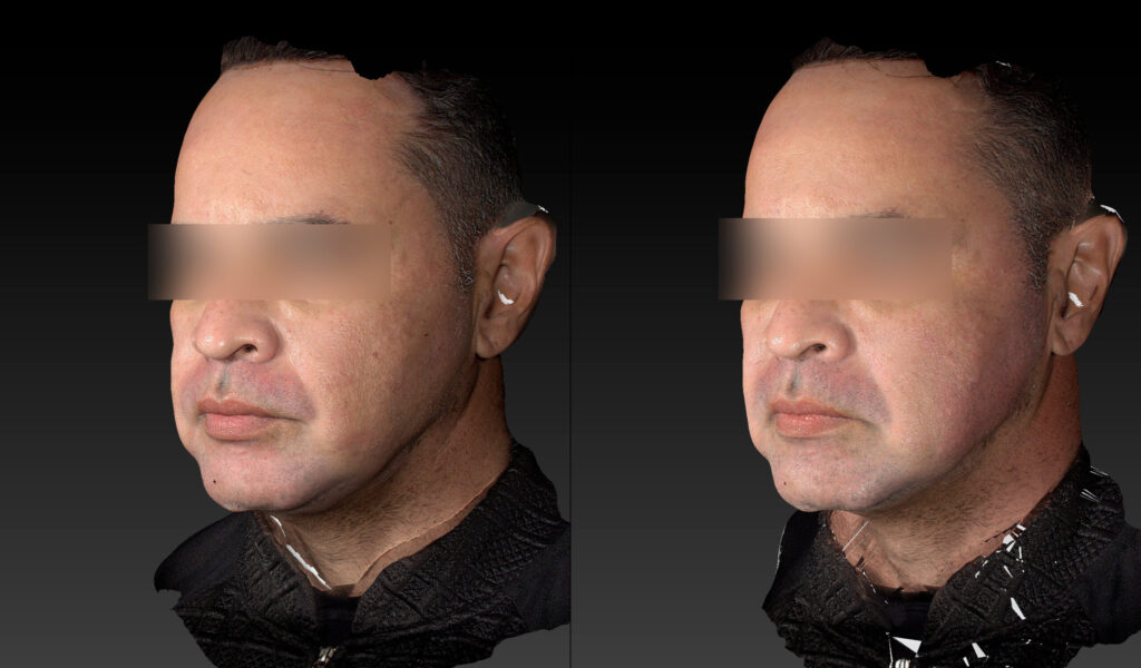 TRATAMENTO LIFTING FACIAL COM ULTRASSOM EM HOMEM