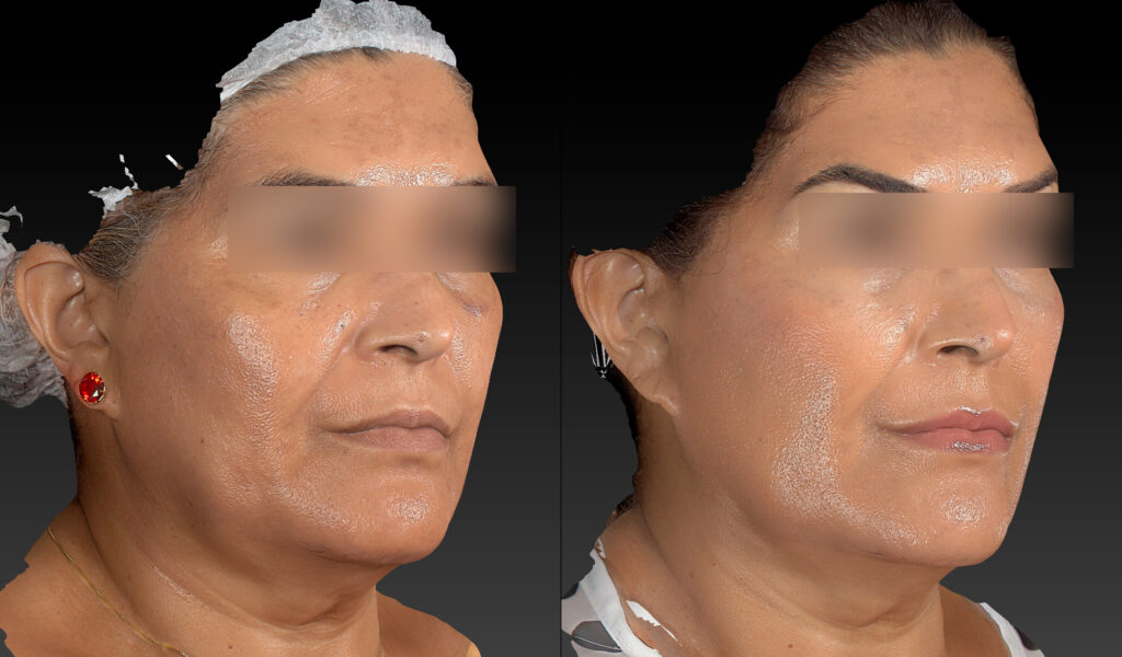 EFEITO LIFT E TRATAMENTO DE MANCHAS ULTRASSOM E LASER