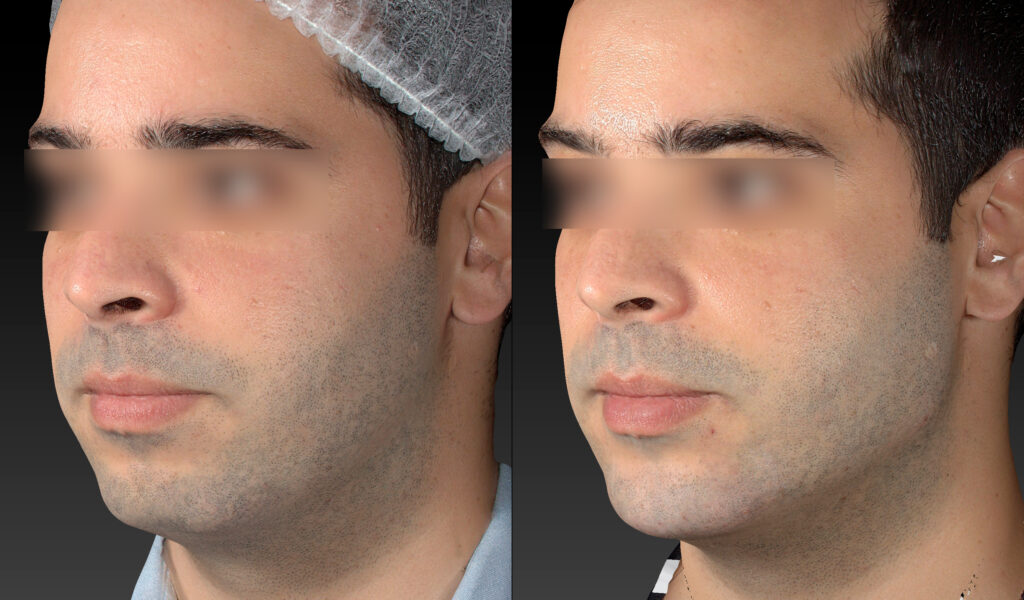 PREENCHIMENTO DE MANDIBULA MASCULINO