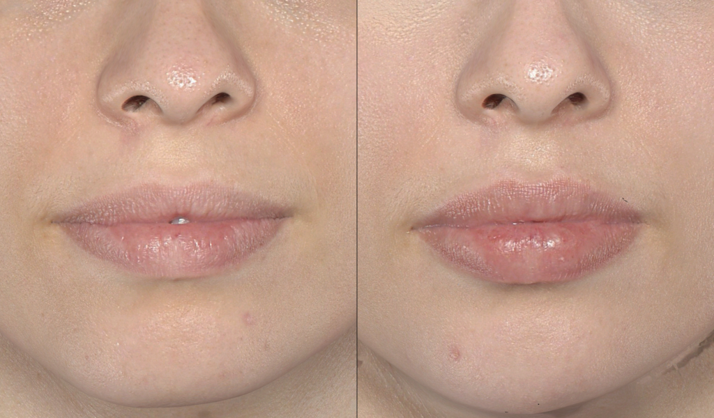 PREENCHIMENTO LABIAL