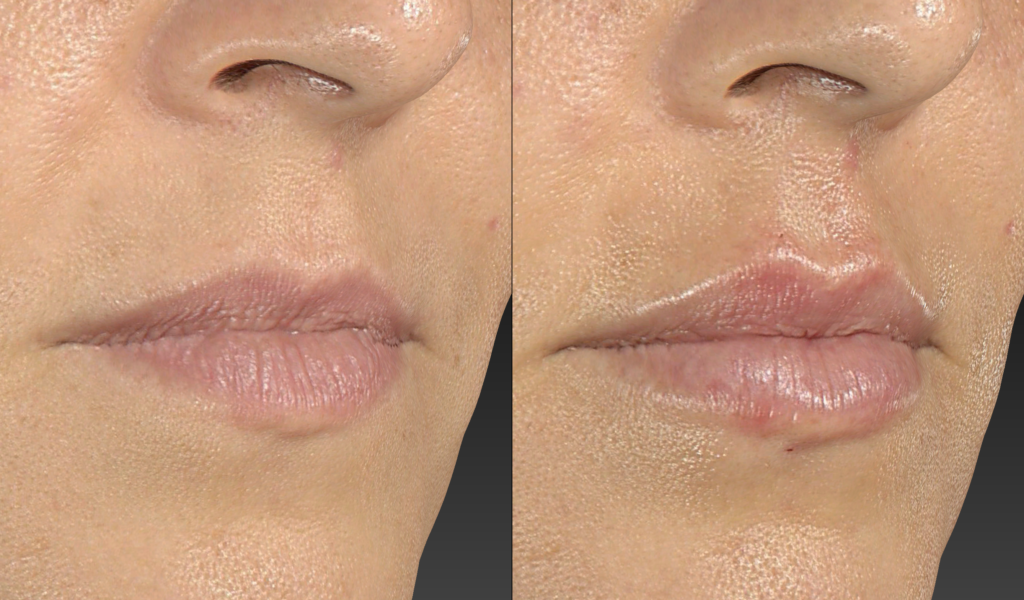 PREENCHIMENTO LABIAL