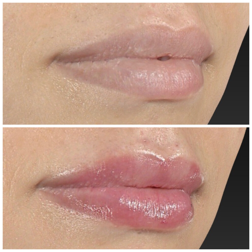 PREENCHIMENTO LABIAL