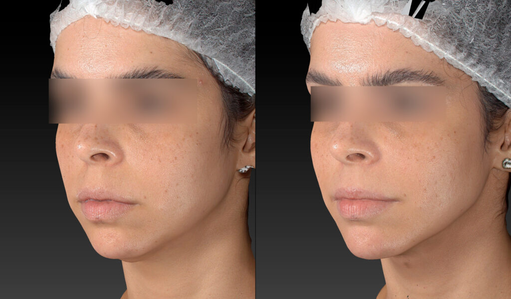 PREENCHIMENTO MALAR E PAPADA