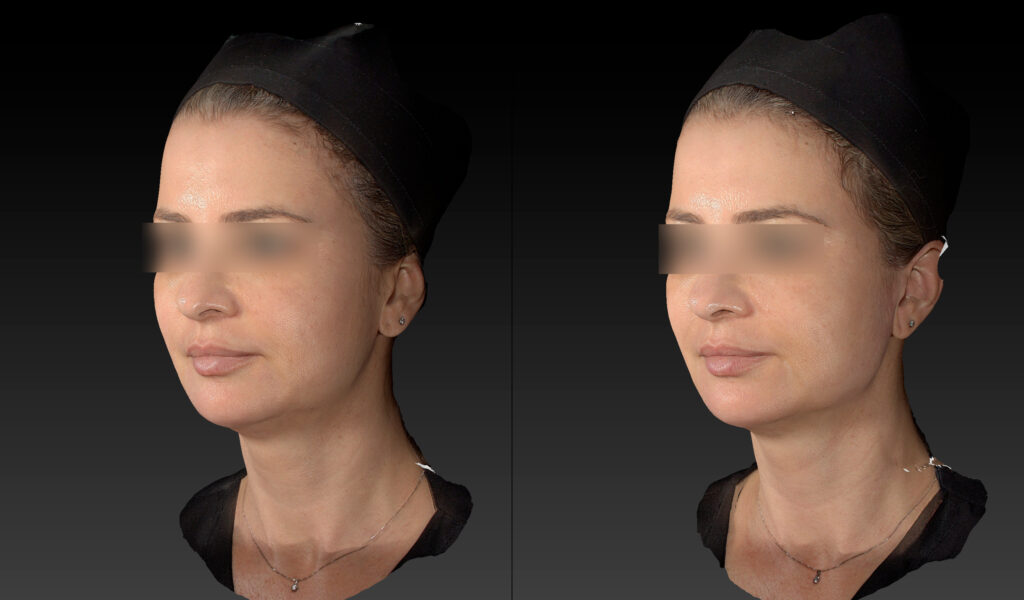 PREENCHIMENTO MANDIBULA