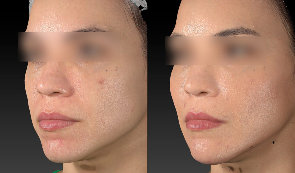 PREENCHIMENTO REJUVENESCIMENTO FACIAL FULLFACE