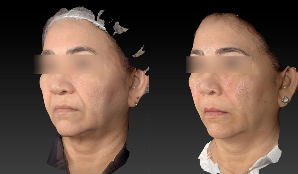 REJUVENESCIMENTO FACIAL E TRATAMENTO FLACIDEZ 50+