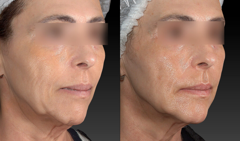 REJUVENESCIMENTO SEM CIRURGIA